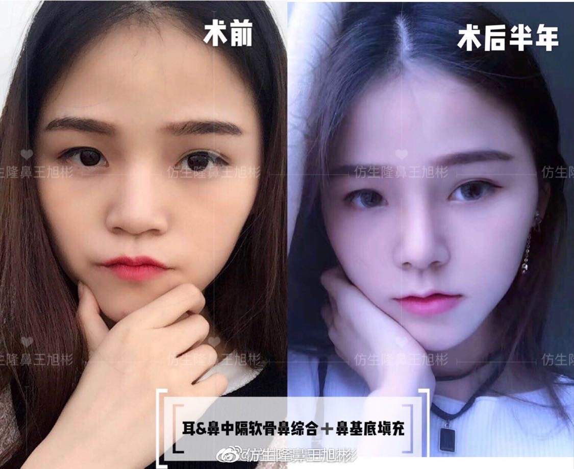 短鼻整形手术,鼻整形短鼻