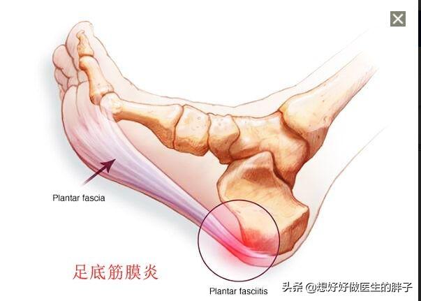 足底骨刺疼痛的原因和治疗方法,足底骨刺痛有什么办法治疗