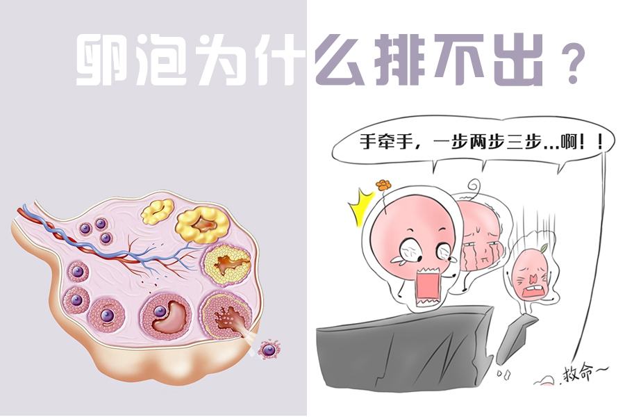多囊朋友,卵泡为什么长不大,排不出?