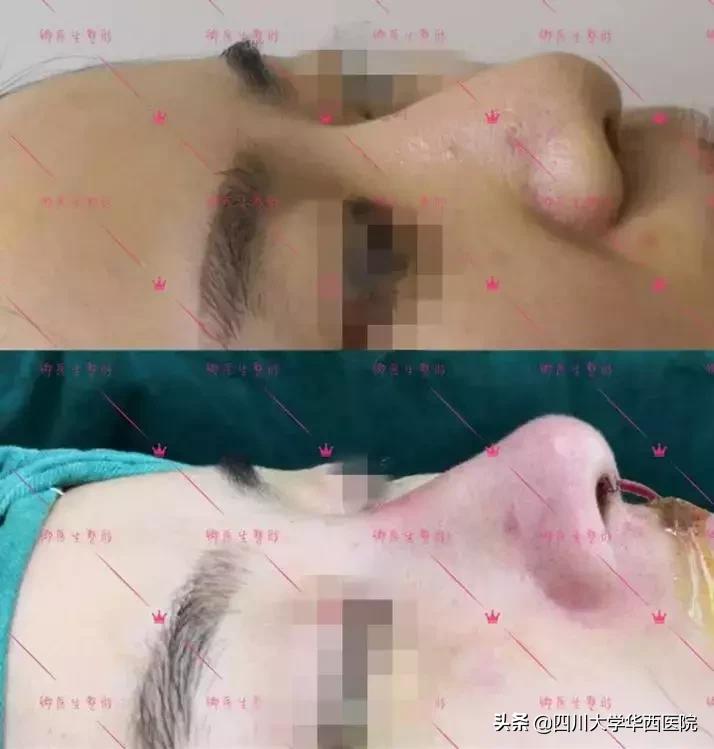 鼻子特别大怎么修,鼻子大如何修鼻子