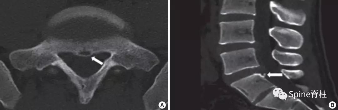 青少年一跑步就腰痛,青少年腰痛是什么原因引起的