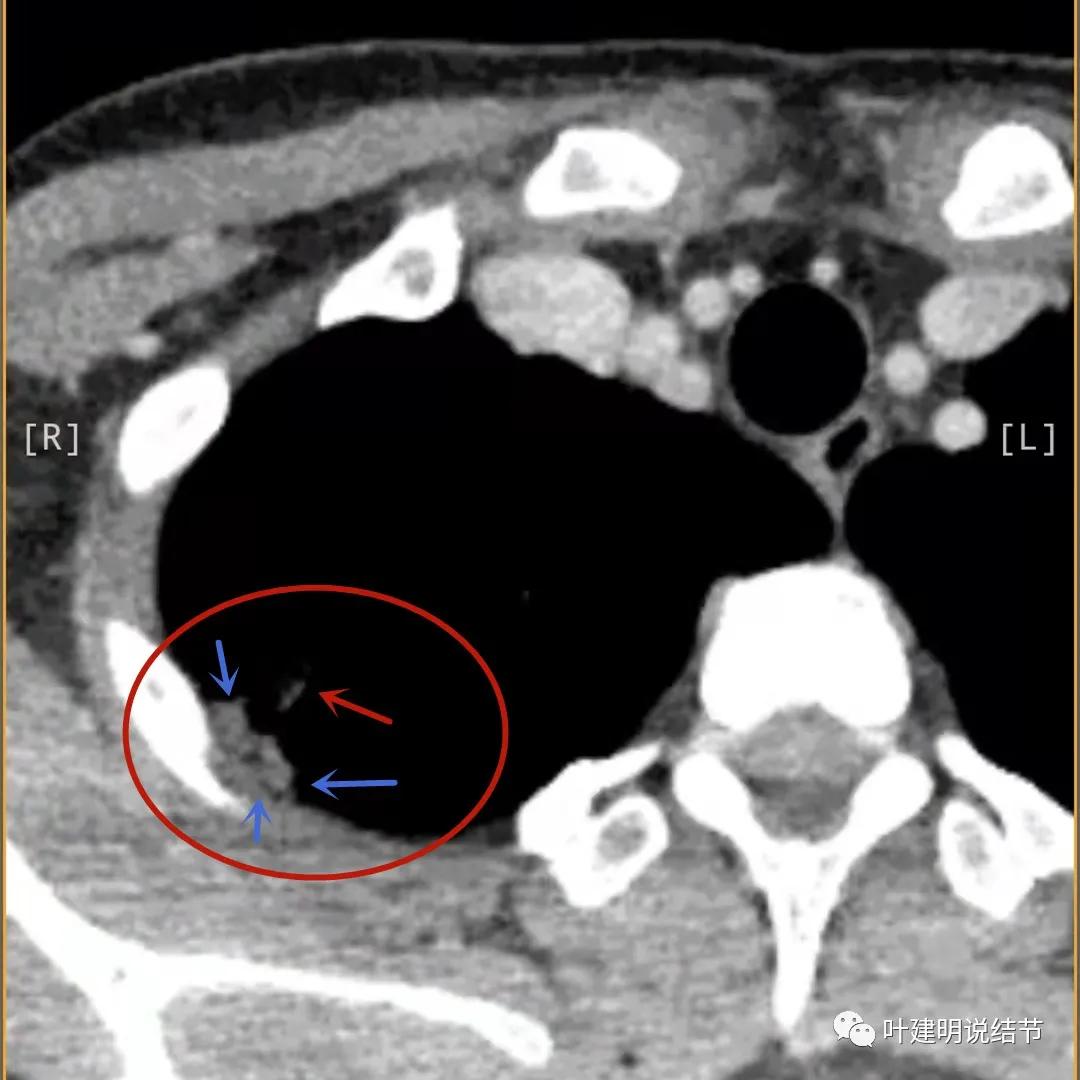临床诊断孤立性肺结节,空洞型结节一般是什么性质