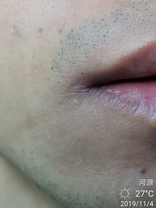 冬季多发口角炎（烂嘴角），中医怎么治？