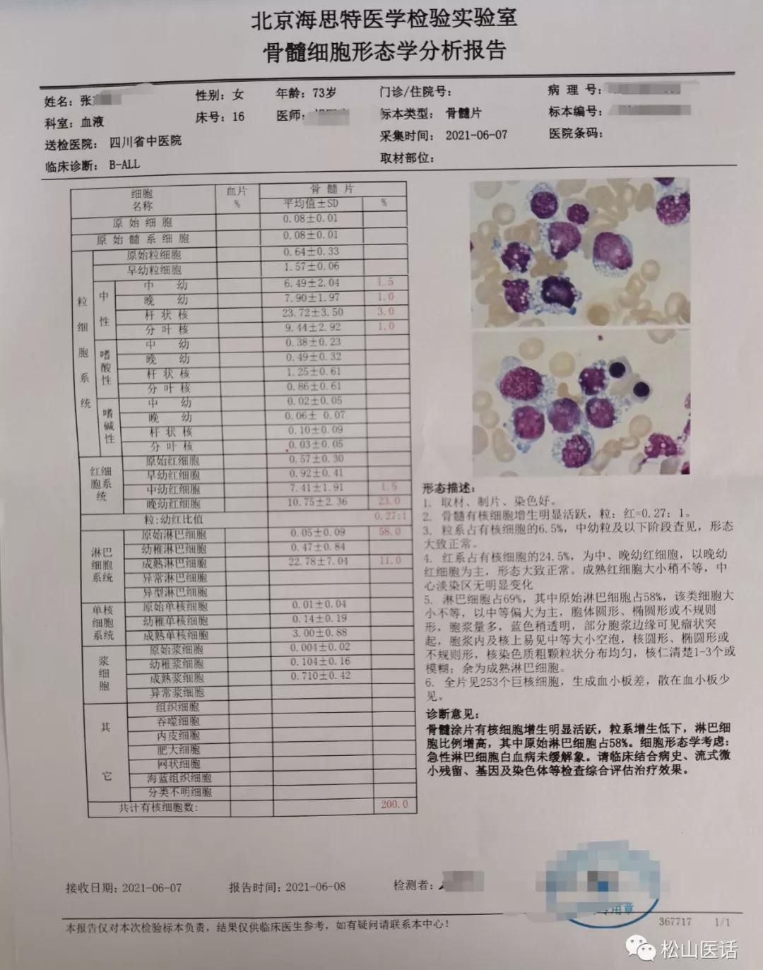 松山医话刘松山教授,松山医生看骨髓增殖性肿瘤怎么样