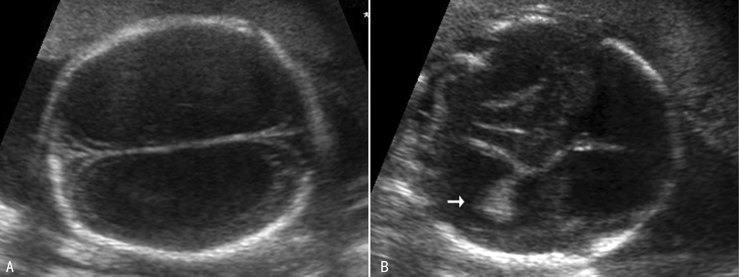 胎儿脑积水的超声图像,胎儿脑积水25m超声图
