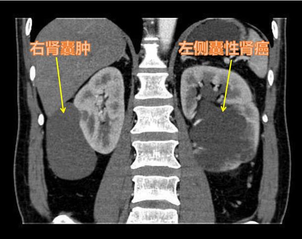 肾囊肿囊壁伴有钙化是肾癌吗,囊性肾癌是由复杂囊肿变化的吗