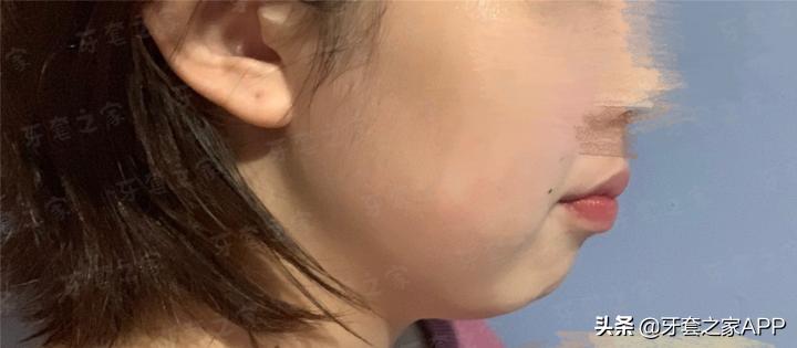 不靠整容怎么改变下巴后缩？看这里