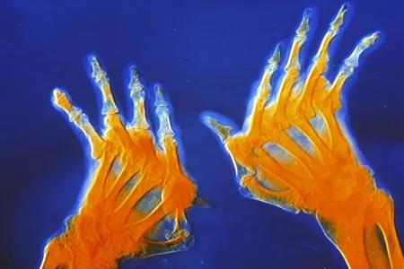 老年人风湿性关节炎用什么方法治,如何缓解风湿关节炎疼痛