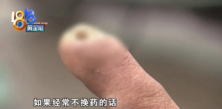 伤口拆线后多久没包纱布了,拆线后发现伤口有小白点