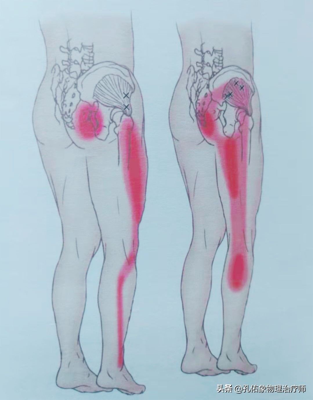 久坐右边臀部疼痛发麻怎么锻炼,久坐臀部疼痛怎么锻炼