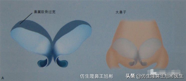 大鼻头能做直鼻微翘吗,可以只做鼻头缩小术吗