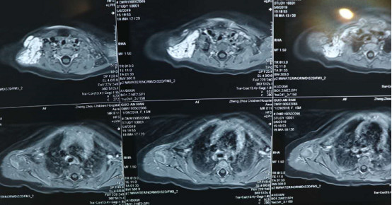 小孩海绵状血管瘤开颅手术,9个小时切除罕见肿瘤