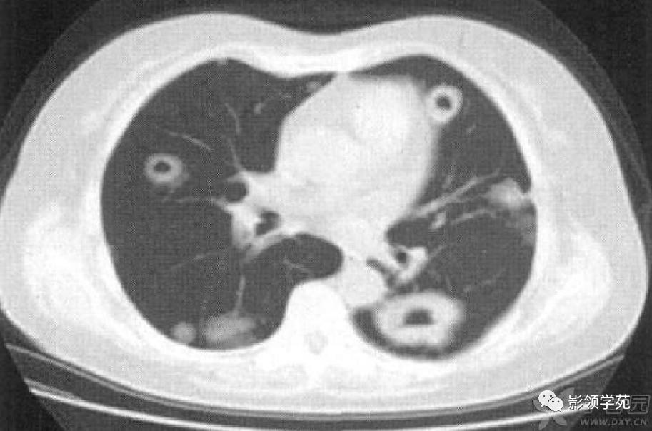 肺肉芽肿影像学表现ppt,肺韦格纳肉芽肿影像学表现