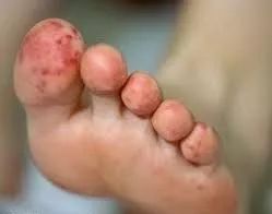 抗凝药华法林的不良反应有哪些？