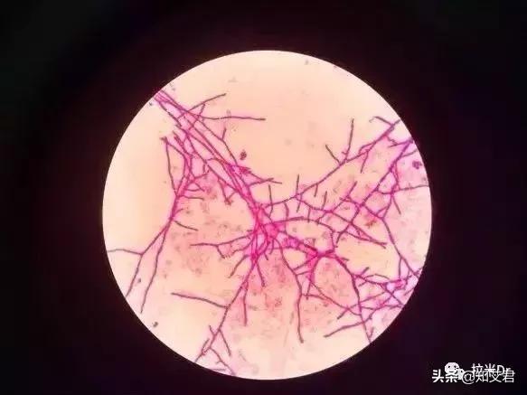 艾滋病患者最易发生的4种真菌感染，其中两种致命性非常高