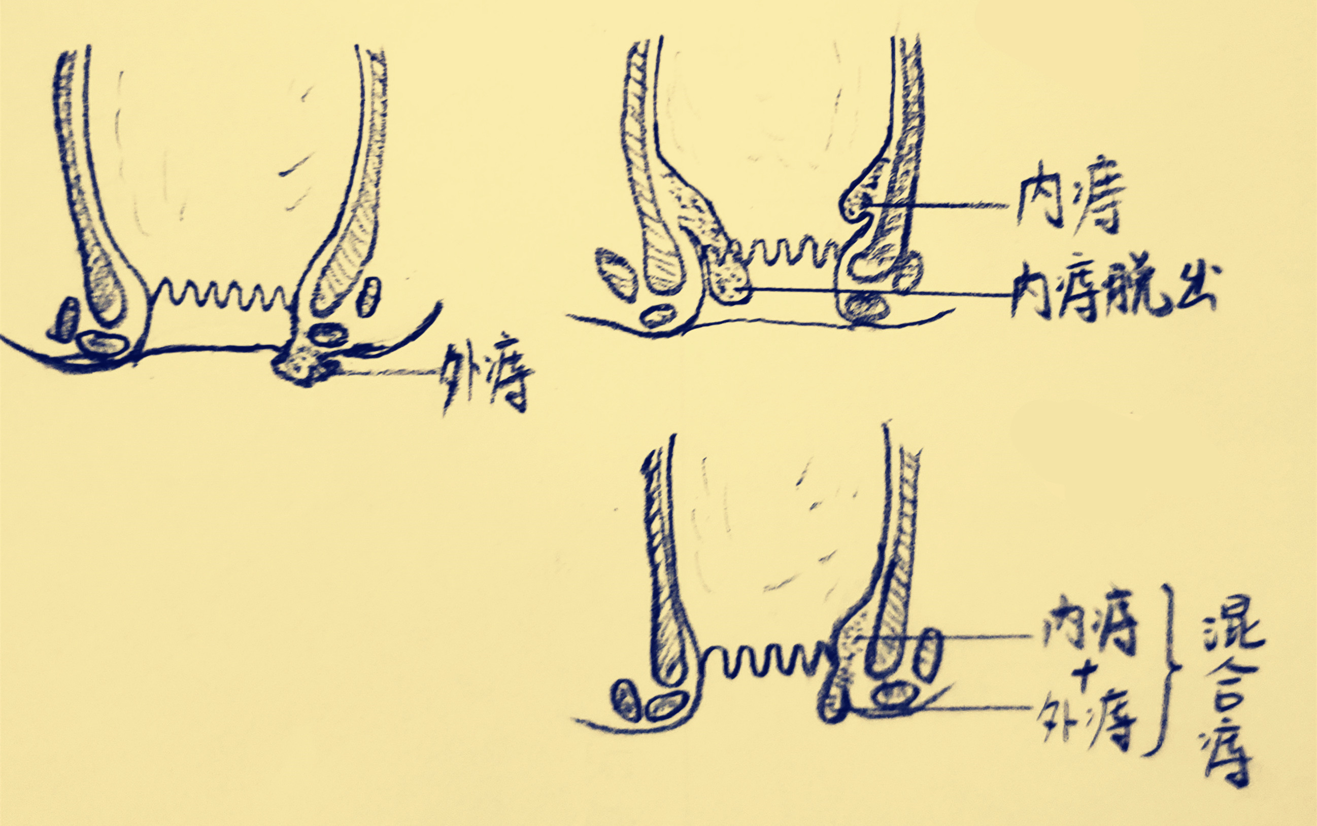 最近屁股有点痛是长痔疮了吗,腚疼严重会不会得痔疮