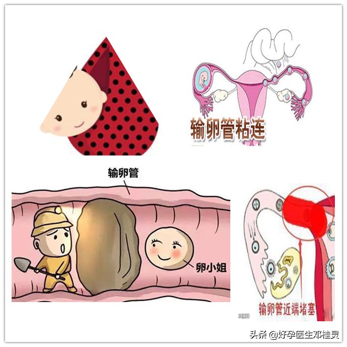 输卵管造影有无痛不插管的吗,检查输卵管通畅有必要查宫腔镜吗