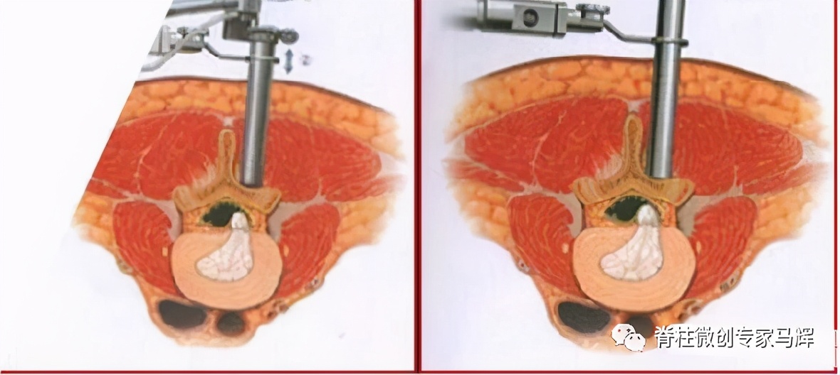 什么是盘源性腰痛,盘源性腰痛真实案例