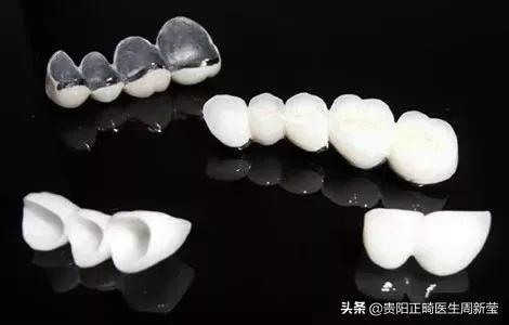 牙釉质表面缺损怎么办,牙釉质破损要怎么修复