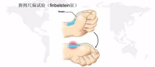 腱鞘炎已经不是妈妈们的专利，它正把魔爪伸向当代年轻人···