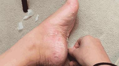 得湿疹了自己会好吗,得了湿疹要忌什么