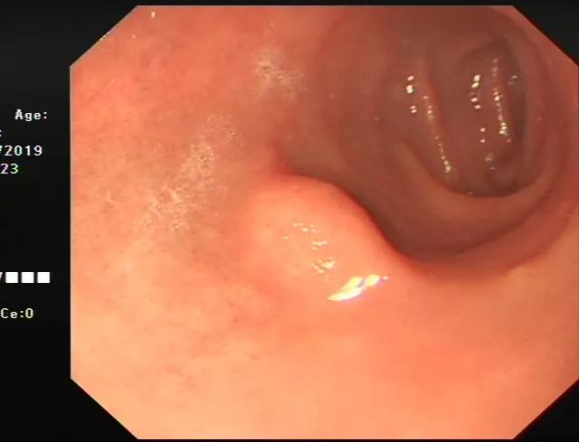 消化内镜发展现状,上消化道超声内镜临床应用