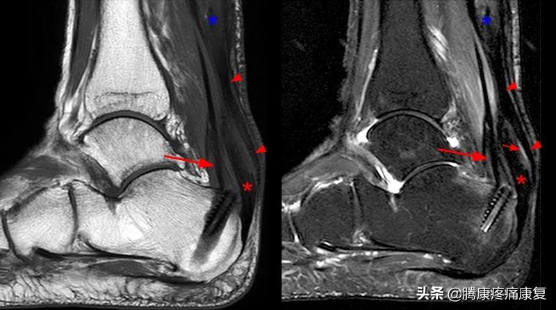 跟腱炎如何预防,跑步怎样预防跟腱炎
