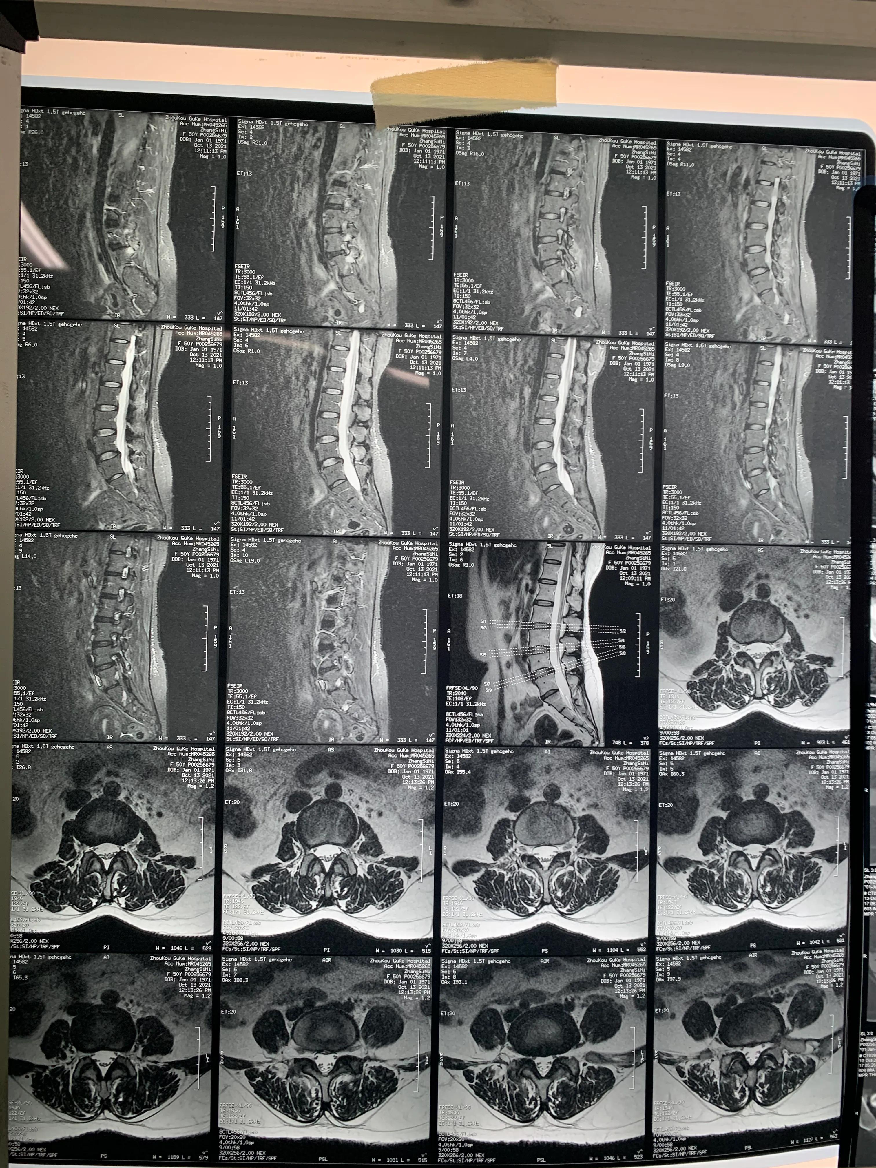 椎间孔镜术后腰痛症状多久消失,盘源性腰痛手术后易复发吗