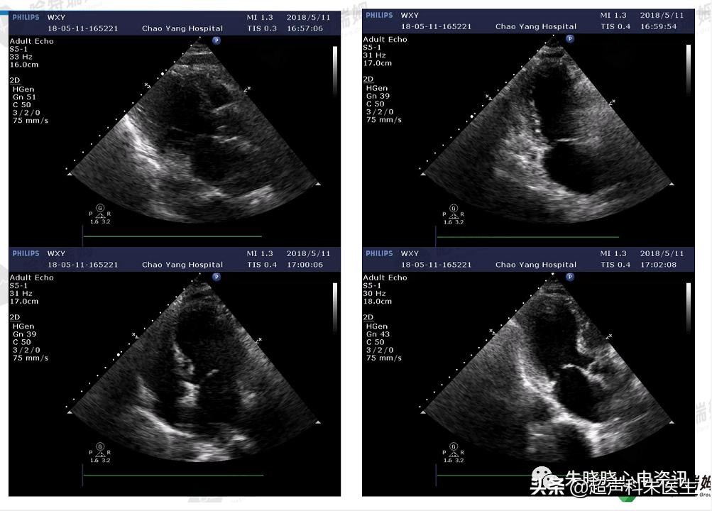 t波倒置9个真相图解,t波倒置判断口诀