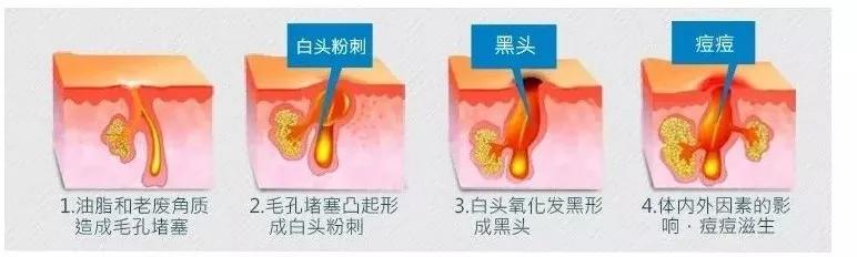 毛孔粗大最好的方法目前最有效的,毛孔粗大怎么缩小自然方法