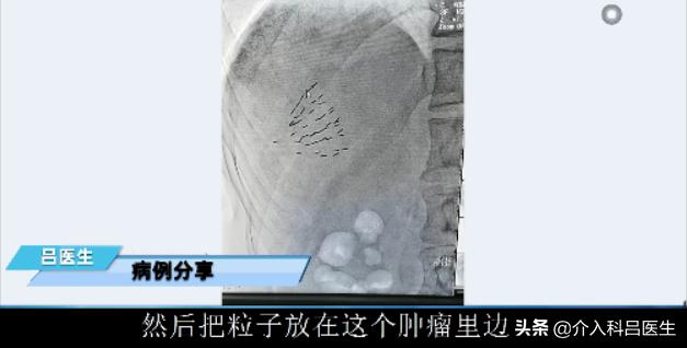 肝上长肿瘤做手术从背后做吗,肝癌介入杀死肿瘤的案例