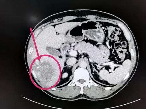 关于肝血管瘤的论文,肝胆外科专家谈肝血管瘤
