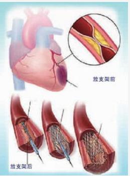 介入疗法的未来前景,介入治疗快速发展