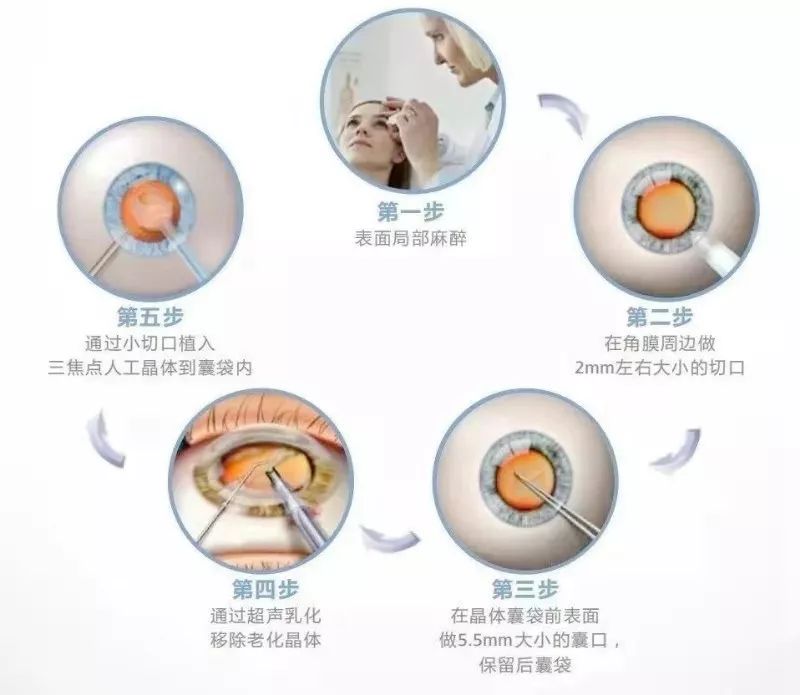 请跟我来，带您了解白内障手术那些事