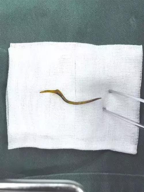 吃了烧烤喉咙剧痛,吃烧烤喉咙剧痛