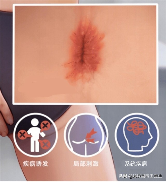 经常肛门瘙痒用啥好的药膏,经常感觉肛门瘙痒怎么回事