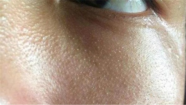 脸上长脂肪粒3个小妙招去除,脸上长了脂肪粒怎么消掉