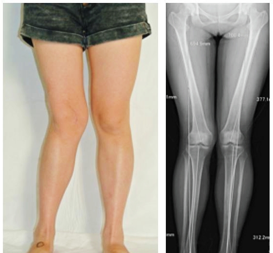 关节炎可以通过打抗生素治疗吗,关节炎治疗的注意事项