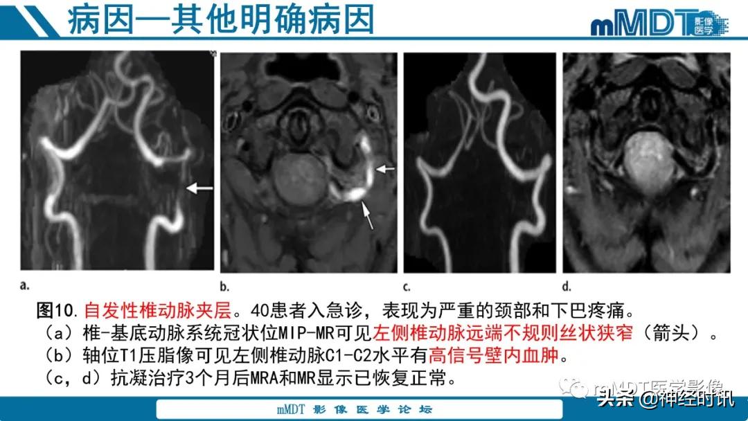 急性缺血性脑卒中ppt素材图片,青年缺血性脑卒中ppt