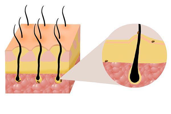 头发上有白色小颗粒怎么回事,掉的头发根部有白色颗粒怎么治