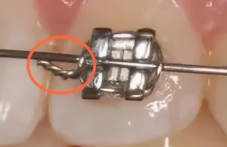 为啥进行牙齿矫正价钱不一样,最好的牙齿矫正需要多少钱