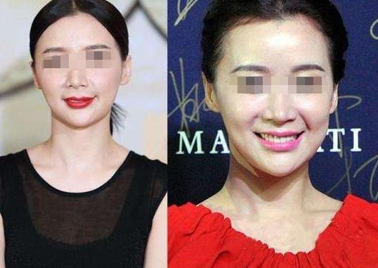 瘦脸针讲解视频,瘦脸针的原理与作用安全有效