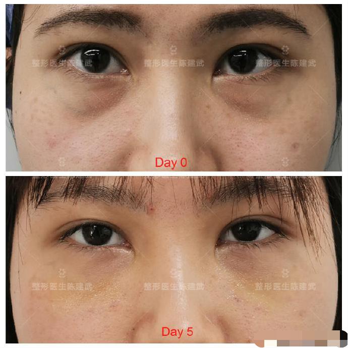 黑眼圈眼袋的最有效的解决方法,眼袋和黑眼圈长一起如何遮住