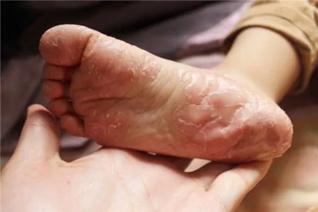 新生儿脱皮很严重是什么原因,新生儿有点脱皮什么原因