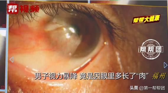常在海边的注意了！男子视力严重下降，一查竟是眼中长了“肉”