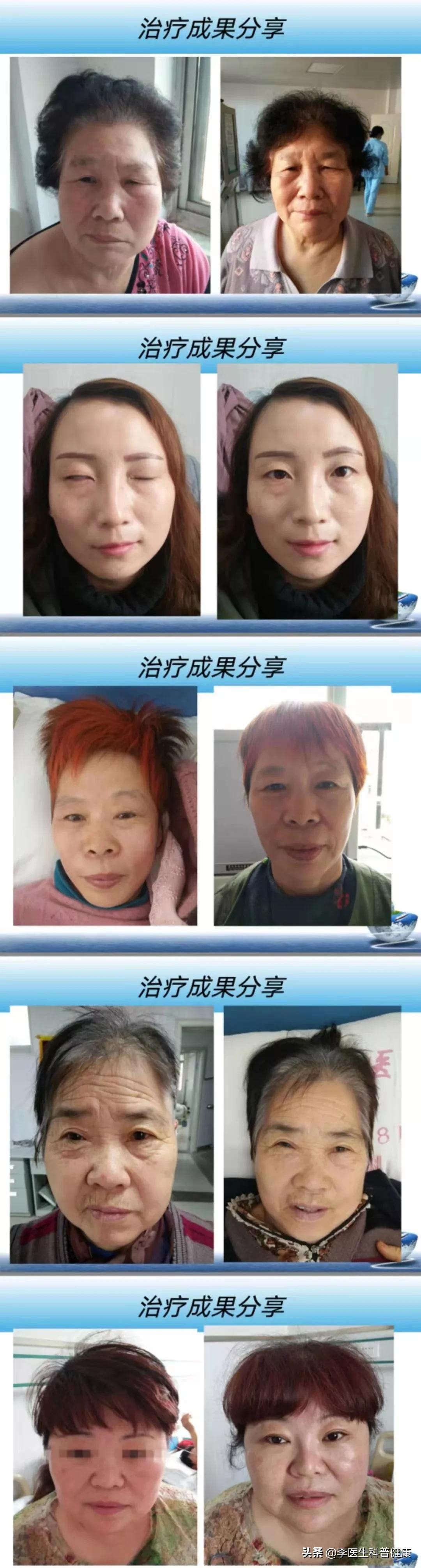 面部吹点冷风,发现眼睛闭不上了,嘴巴也歪了,到底是咋回事儿?