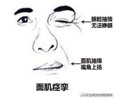 什么叫面肌痉挛,非典型面肌痉挛如何治疗
