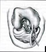 膝关节前叉韧带损伤最佳恢复方法,膝关节前韧带断了必须手术吗