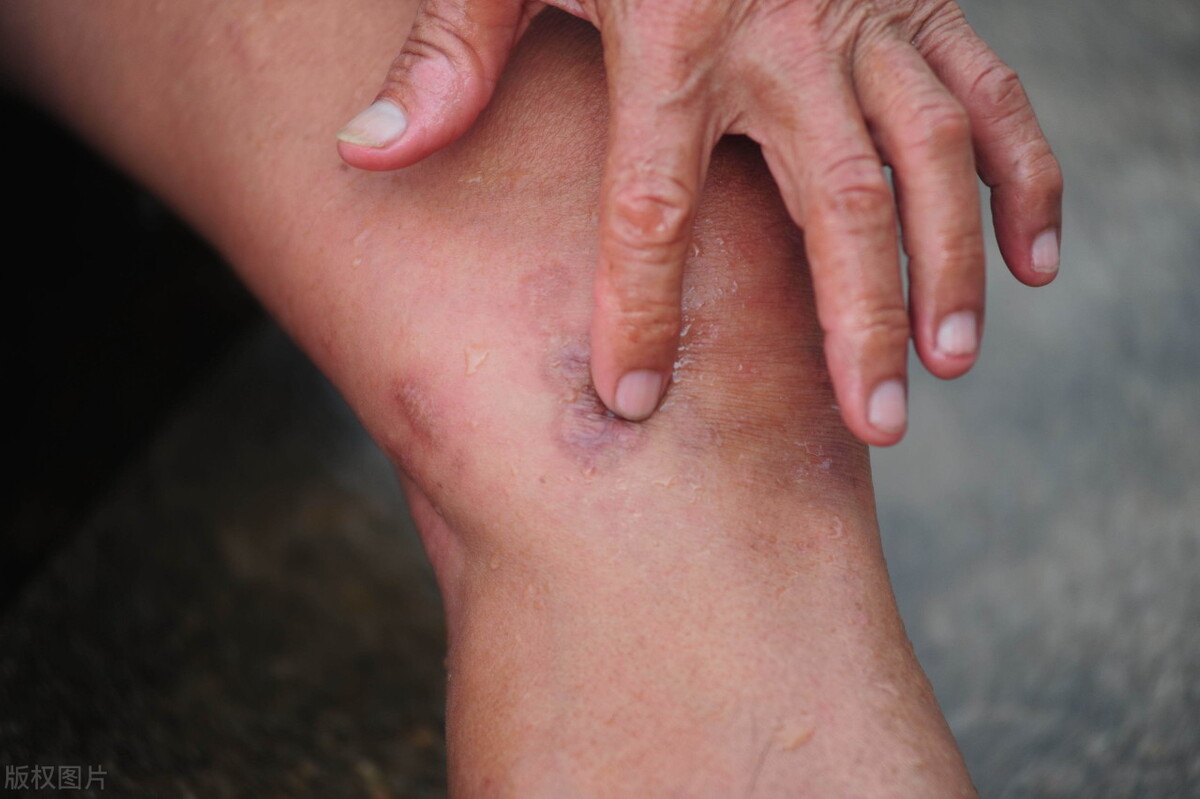 痛风不可治愈？中医道出真相：知其道，可愈也