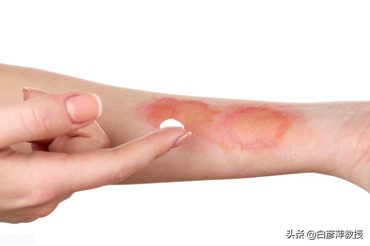 皮肤科医生眼中的真相,皮肤科激素皮炎